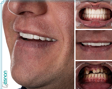 Experience expert implant placement in Turkey. Benefit from advanced techniques and personalized care for a seamless dental experience.